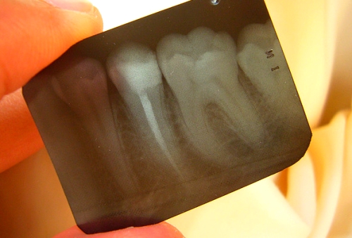 Síndrome del diente fracturado; que es
