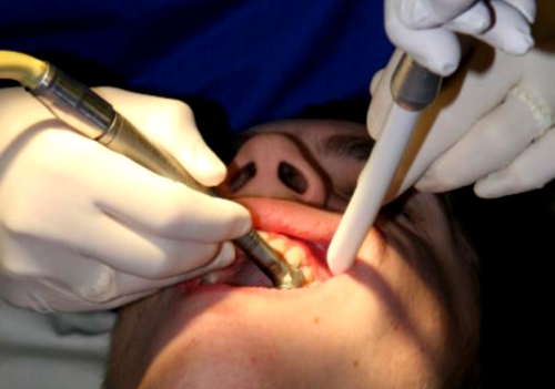 Síndrome de diente fracturado; tratamientos