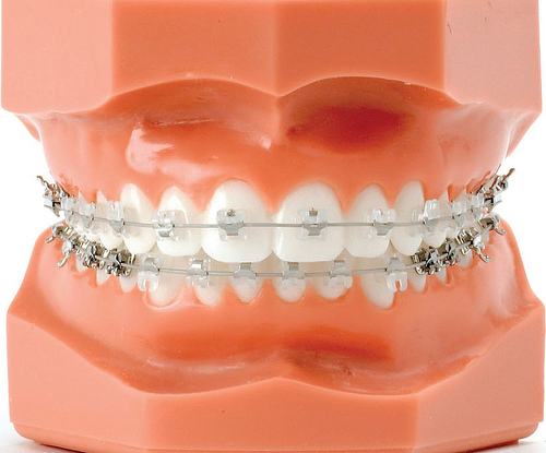 Elásticos en la ortodoncia