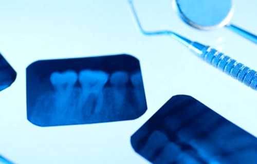 Rayos X dentales detectarían la osteoporosis