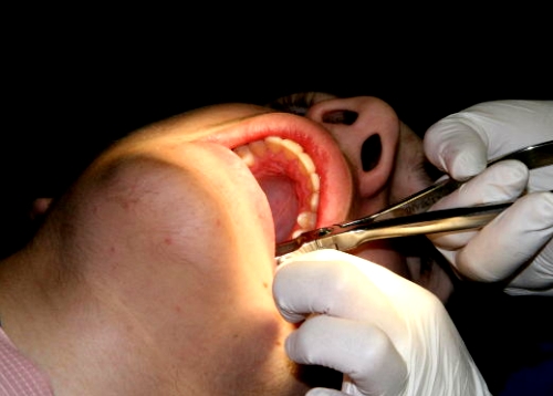 Tratamientos para la enfermedad periodontal avanzada