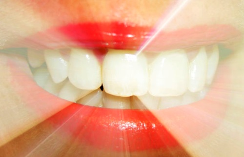 Blanqueadores dentales podrían debilitar el esmalte
