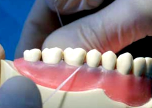 hilo dental, reduciría el riesgo al cáncer