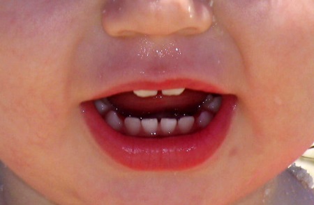 Salud dental infantil