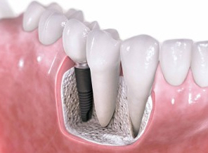 implantes-dentales