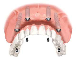 Implantes dentales de calidad: consejos para evitar fraudes