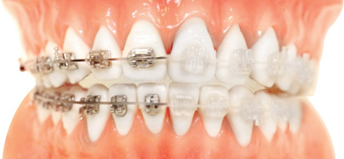 ortodoncia tradicional vs zafiro