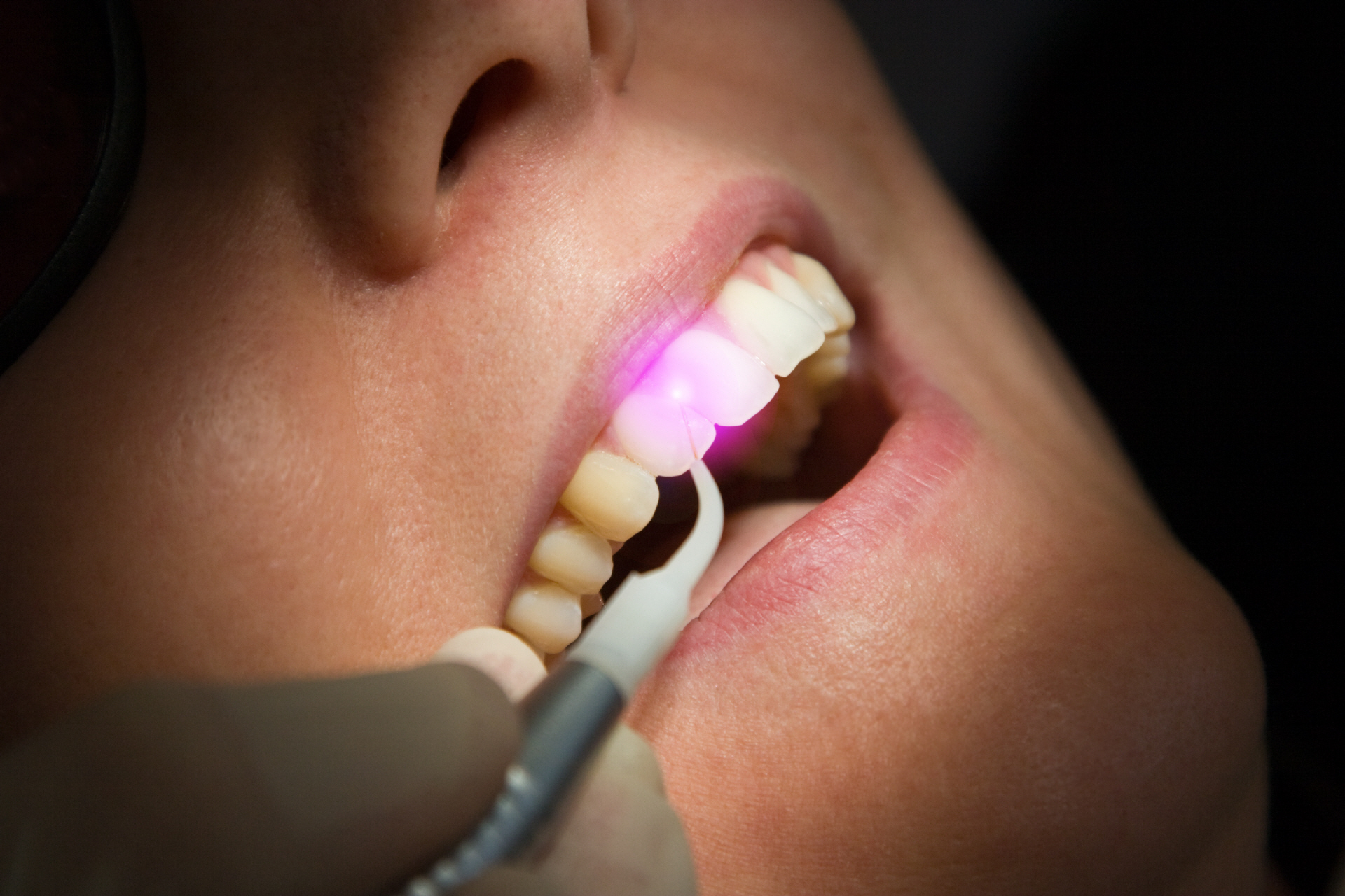 Qué es la láserterapia dental