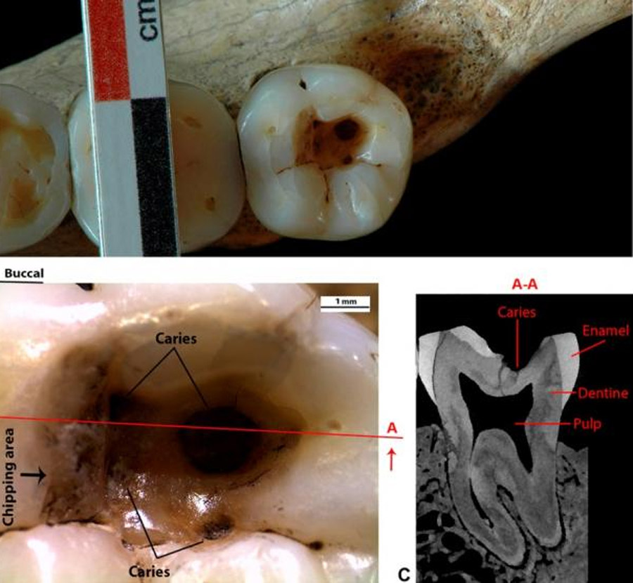 Se descubrió un diente con más de 14 mil años