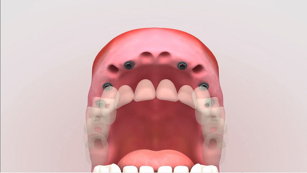 Qué hacer si se pierde un diente