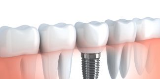 dentistas en madrid implantologia