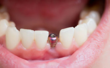 limpieza-implantes-dentales