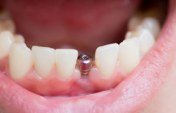 limpieza-implantes-dentales