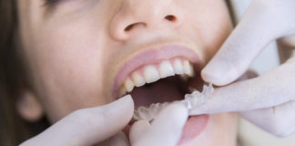 ortodoncia invisalign adultos