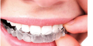 ortodoncia-invisalign