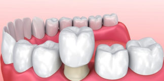 dentista-en-tu-ciudad-coronas-dentales