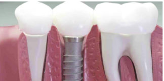 implantes-dentales-en-madrid-centro