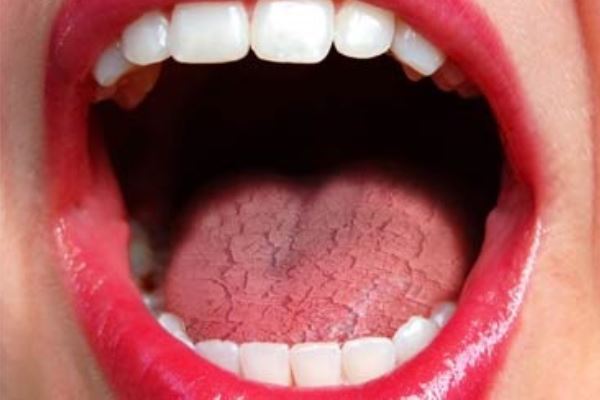 boca seca xerostomia