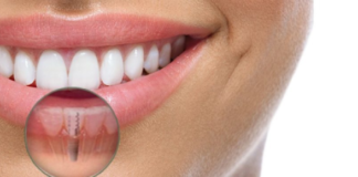 clinica implantes dentales madrid