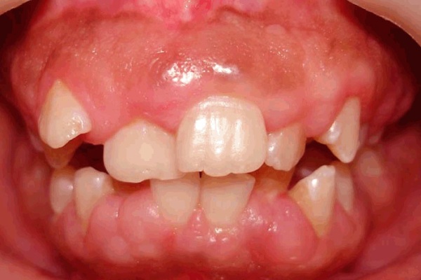 fibrosis gingival