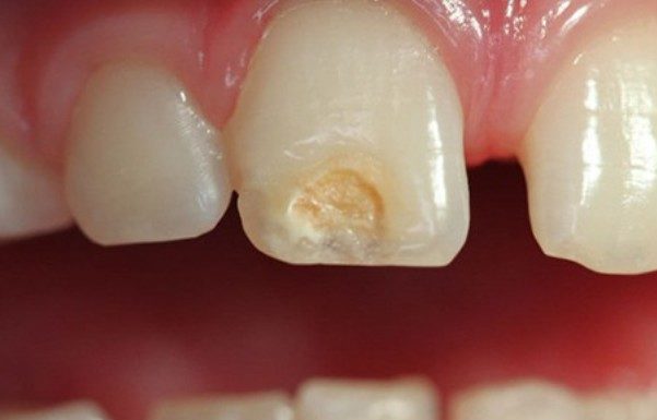 hipoplasia-dental-esmalte