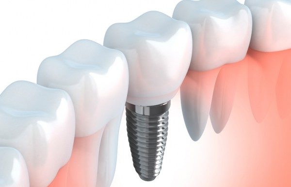 implante dientes