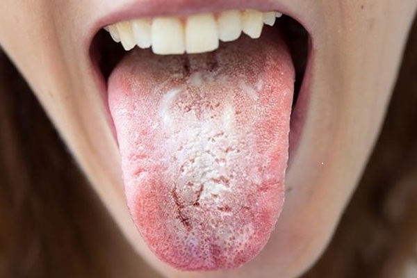 xerostomia o boca seca