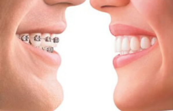 invisalign, ortodoncia invisalign, brackets, ortodoncias