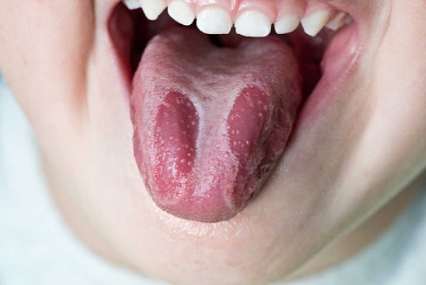enfermedades de la lengua