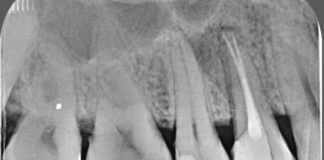 diente fisurado