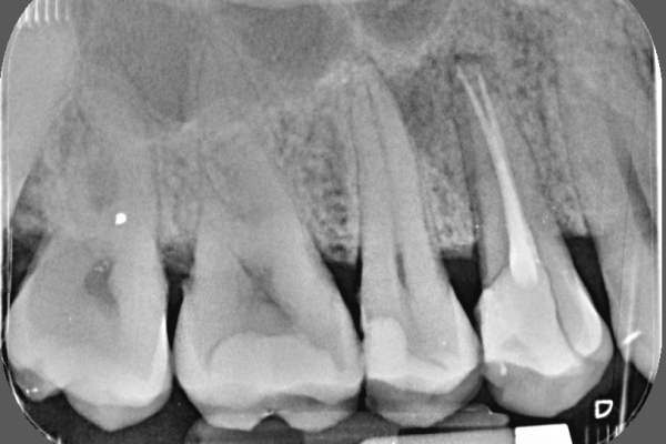 diente fisurado