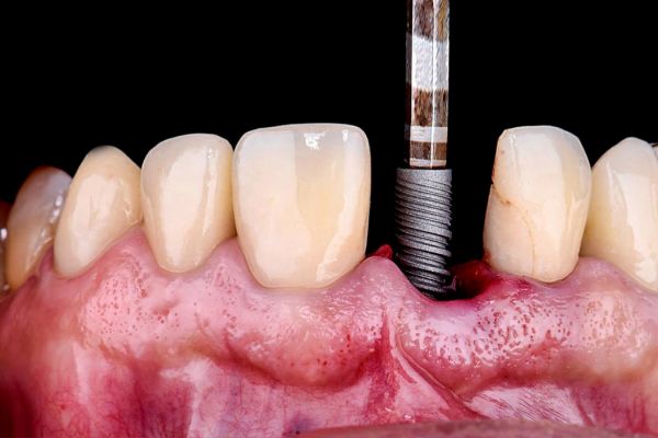 implantología dental