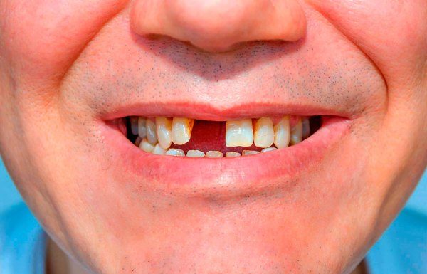 prevenir perdida de dientes