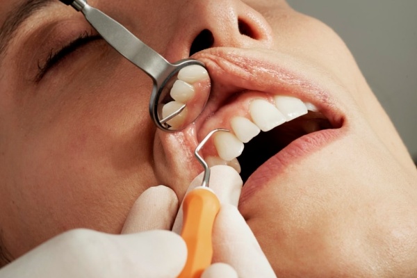 fisura dental tipos