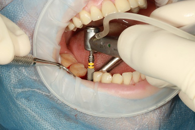 ¿Cuánto cuesta ponerse implantes dentales?