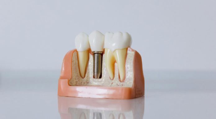 Los implantes dentales serán tan frecuentes como los empastes
