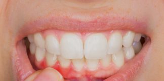 ¿Qué consecuencias puede tener sufrir una enfermedad periodontal?  