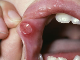cancer oral