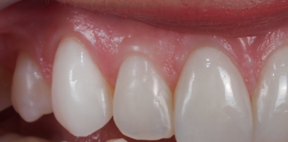 resina dental