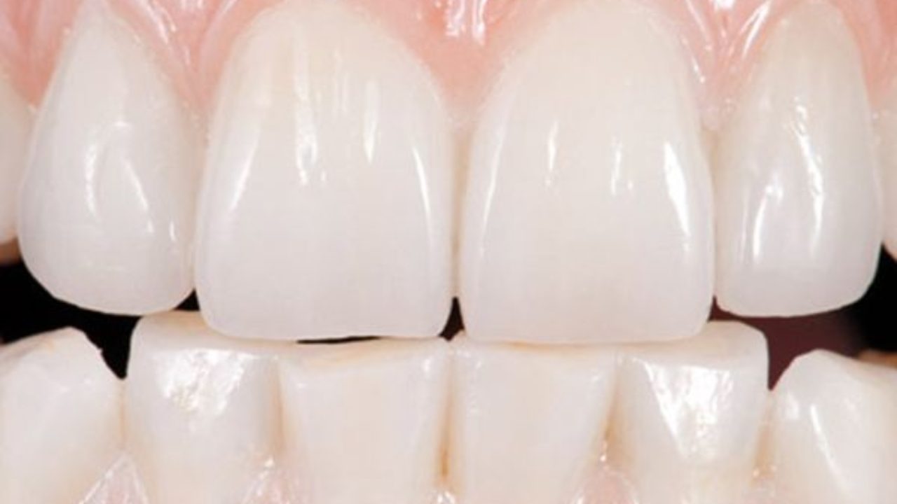 Hay una forma de regenerar el esmalte dental | Noticias Dentales