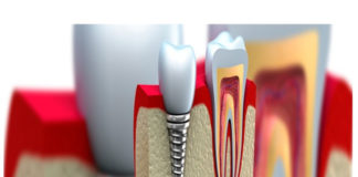 dentistas-en-madrid-implantes-dentales-clinica-dental-pilar-garrido