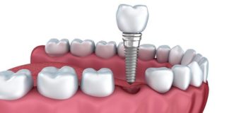 implantes-dentales-en-madrid
