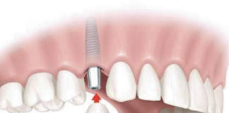 implante dentales
