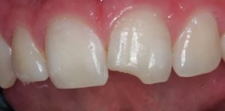 reinsercion dental