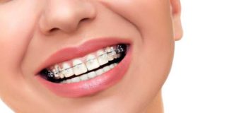 ortodoncia y blanqueamiento