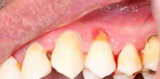 periodontitis riesgos