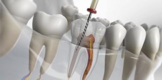 Endodoncias ¿Cómo pueden llegar a complicarse?