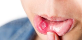 ulceras orales complicadas
